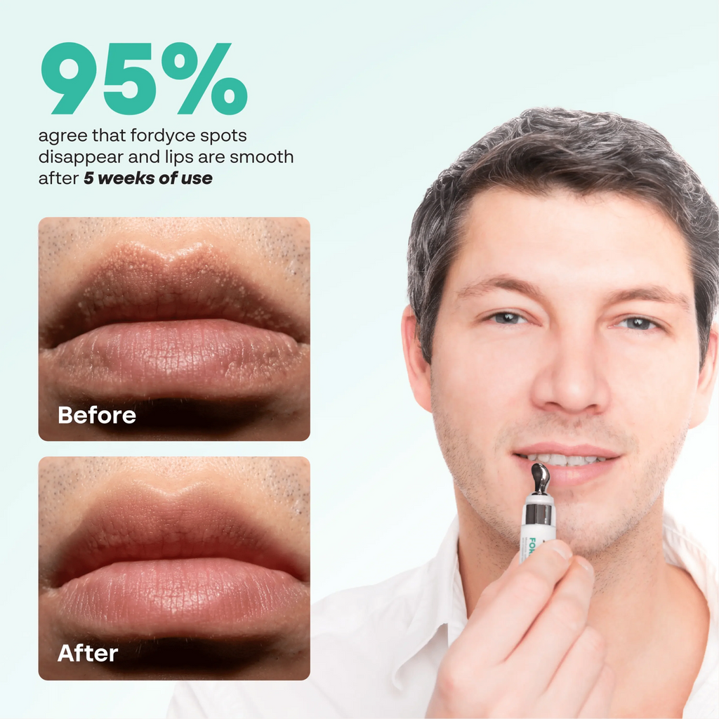 Abera Fordyce Cream | Moisturizing Lip Care with HPR