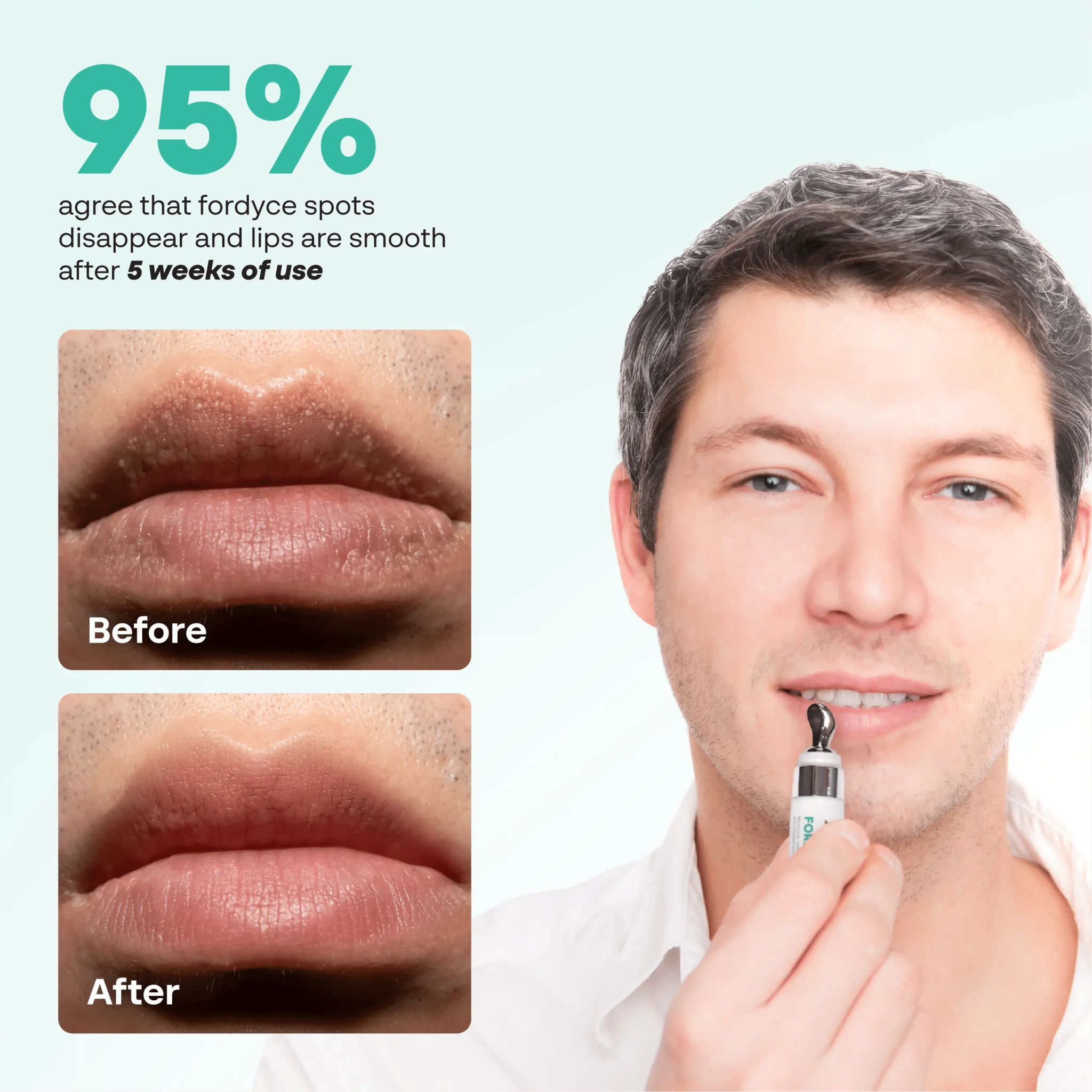 Abera Fordyce Cream | Moisturizing Lip Care with HPR