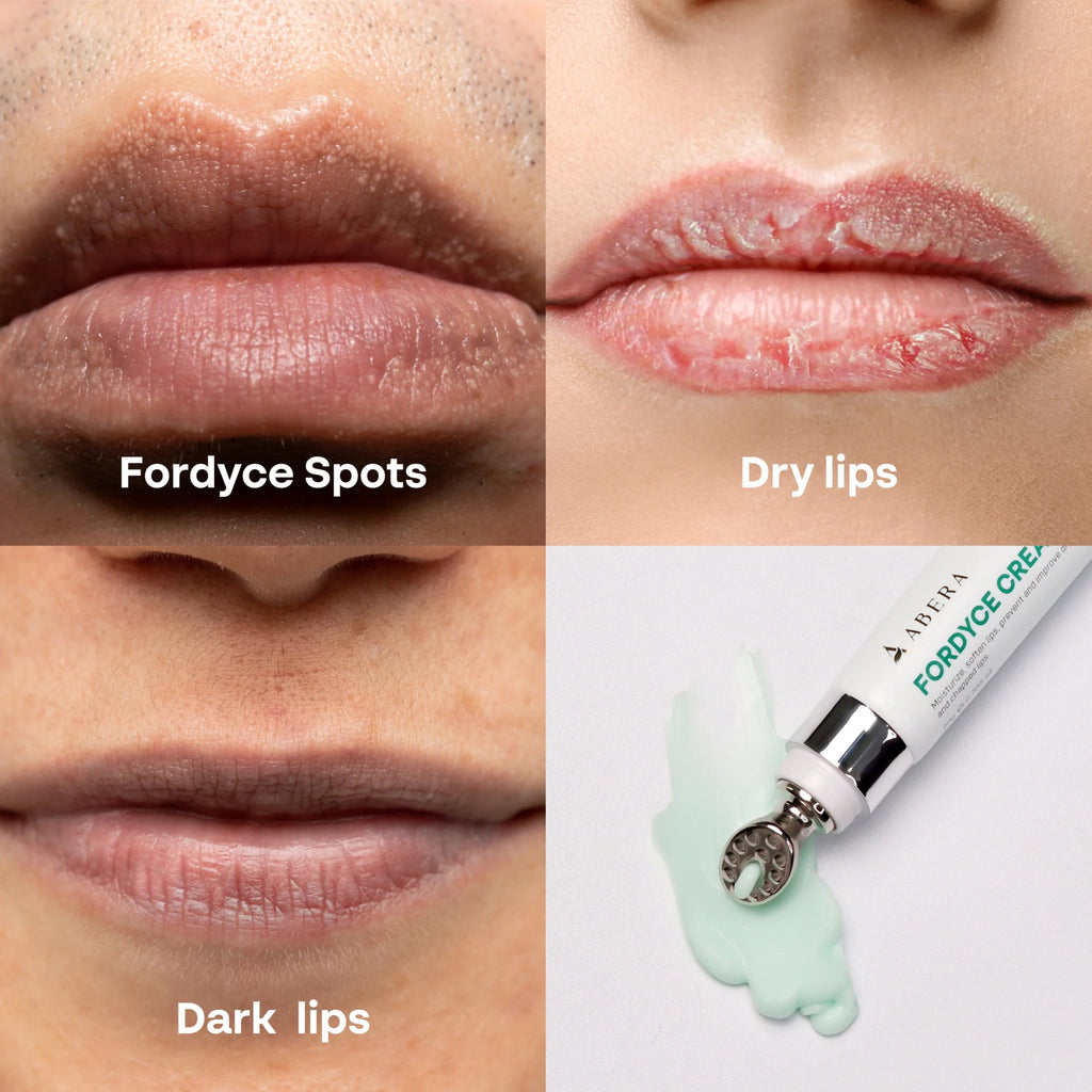 Abera Fordyce Cream | Moisturizing Lip Care with HPR