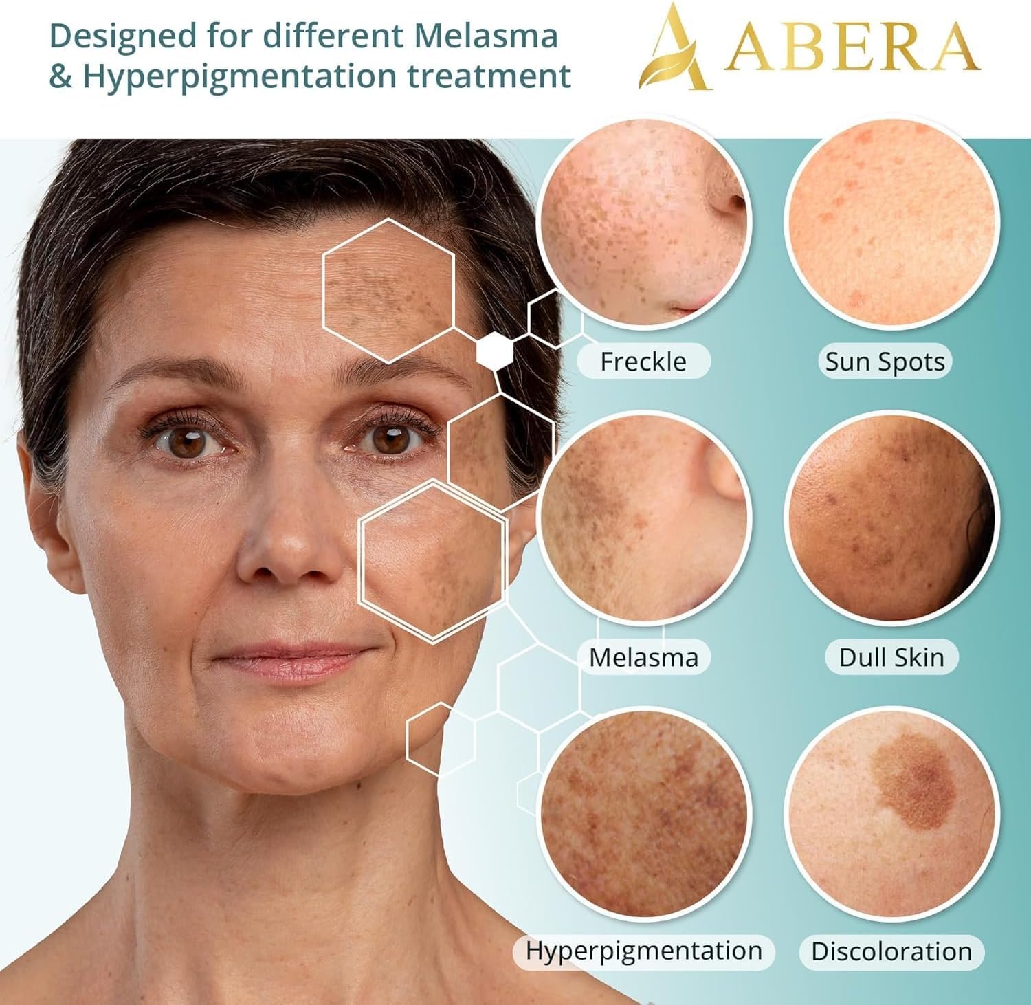 Abera Melasma Serum, Melasma Treatment for Face, Dark Spot Corrector Serum, Melasma Dark Spot Remover, Sun Spot, Age Spot, Brown Spot Remover for Men, Women - ABERA SHOP