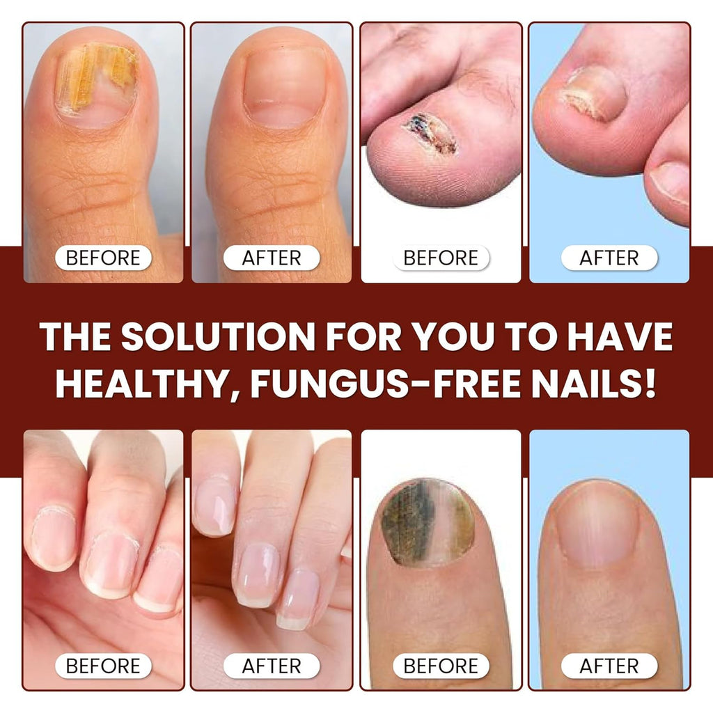 Abera Nail Fungus Serum - Hydrating & Conditioning Formula for Dry or Hardened Nails – Quick - Drying Daily Nail Support - ABERA SHOP