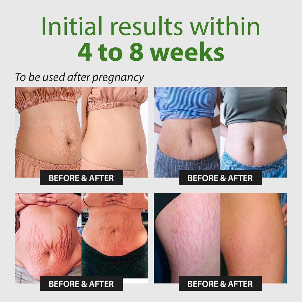 Abera Ovela Stretch Mark Cream - ABERA SHOP