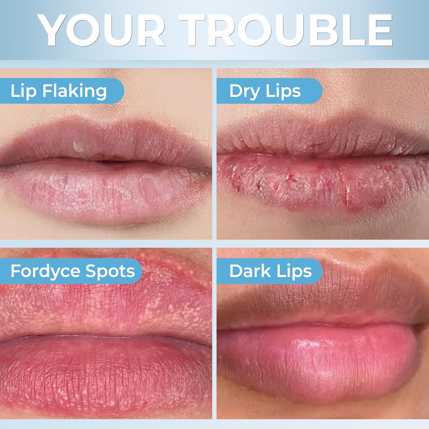 Fordyce Seeds Lip Lightening Cream - Moisturizing Lip Care Balm - 20ml - ABERA SHOP